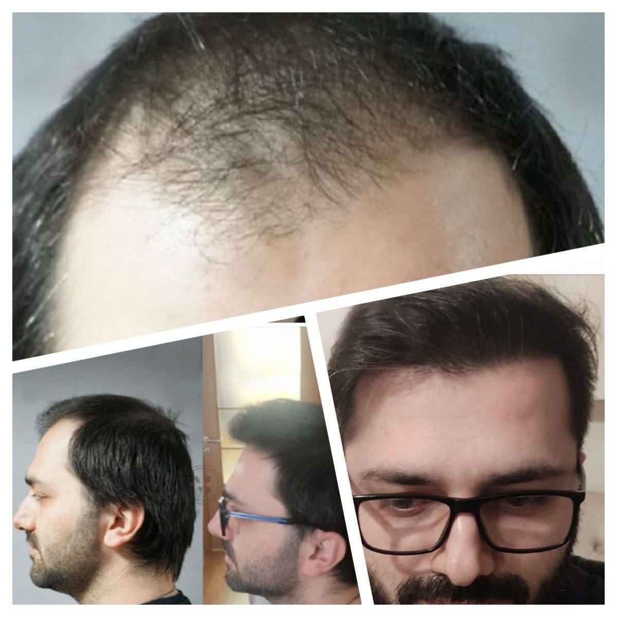 عوارض کاشت مو به روش FIT