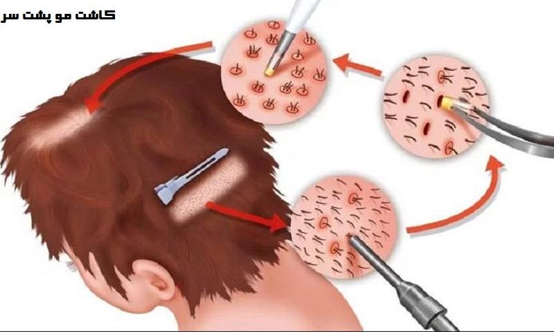 کاشت مو پشت سر